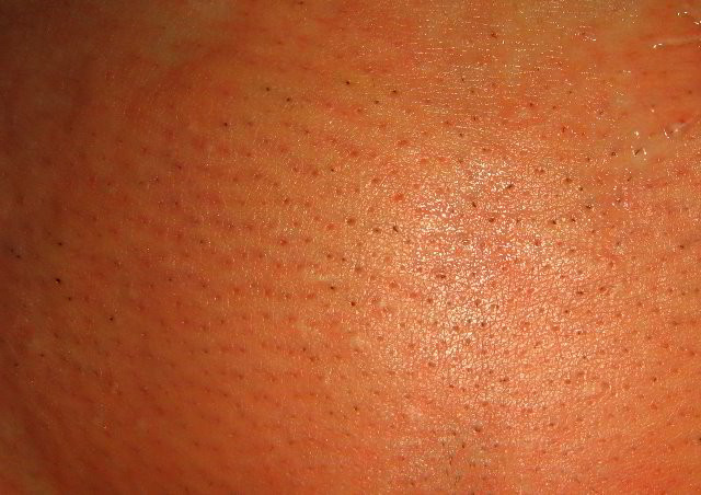 Гиперемия или покраснение кожи после лазерной эпиляции