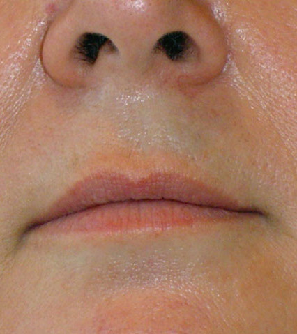 Лазерная эпиляция верхней губы после процедуры