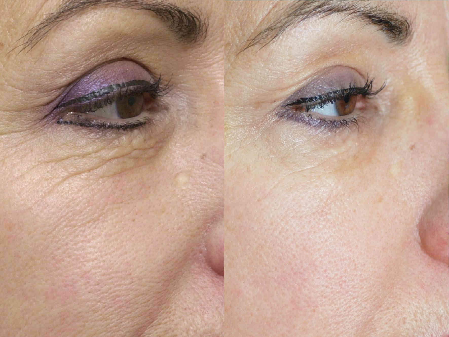Устранение морщин вокруг глаз методом фототерапии IPL