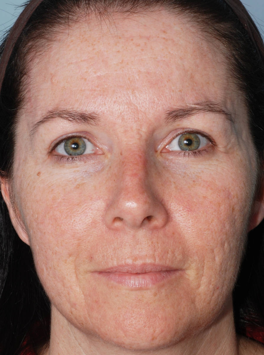 Омоложение кожи лица методом фототерапии IPL до процедуры
