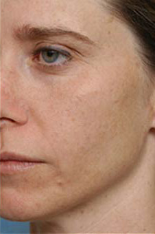 Устранение пигментации на лице с помощь пилинга после процедуры