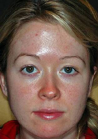 Устранение угревой сыпи на лице с помощь пилинга до процедуры