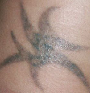 Удаление лазером татуировок