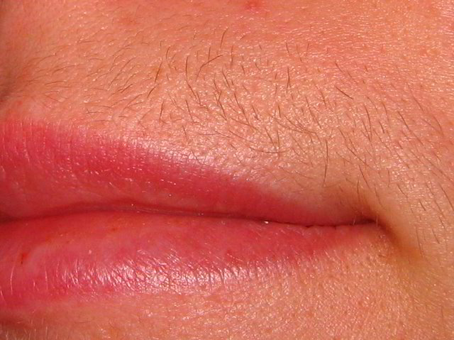 Верхняя губа до лазерной эпиляции