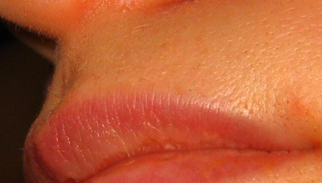 Верхняя губа 12 часов после четвертой процедуры лазерной эпиляции
