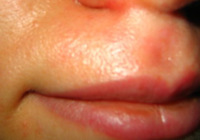 Верхняя губа сразу после четвертой процедуры лазерной эпиляции