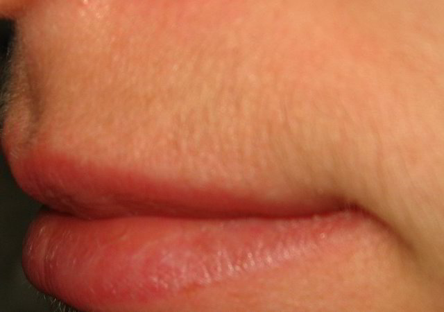 Верхняя губа 15 неделя после четвертой процедуры лазерной эпиляции