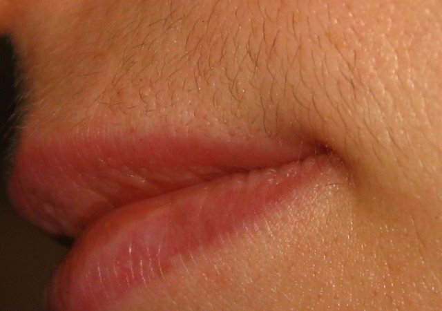 Верхняя губа 12 неделя после четвертой процедуры лазерной эпиляции