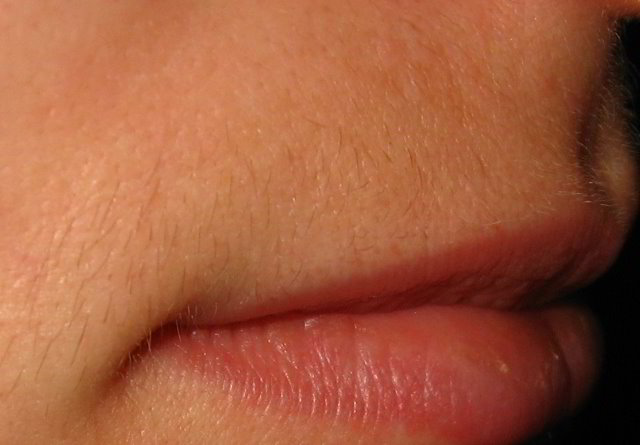 Верхняя губа 26 неделя после четвертой процедуры лазерной эпиляции