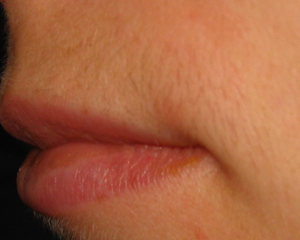 Верхняя губа 26 неделя после четвертой процедуры лазерной эпиляции
