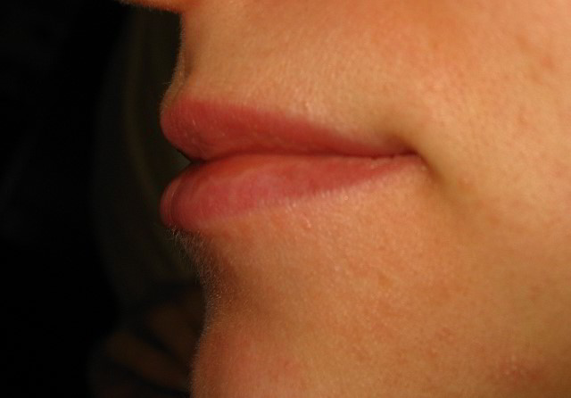 Верхняя губа 3 недели после девятой процедуры лазерной эпиляции