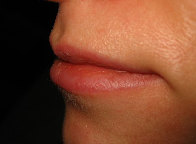 Верхняя губа после девятой процедуры лазерной эпиляции