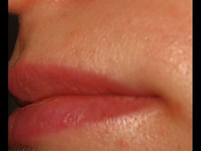 Верхняя губа сразу после пятой процедуры лазерной эпиляции