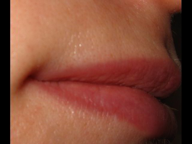 Верхняя губа сразу после пятой процедуры лазерной эпиляции