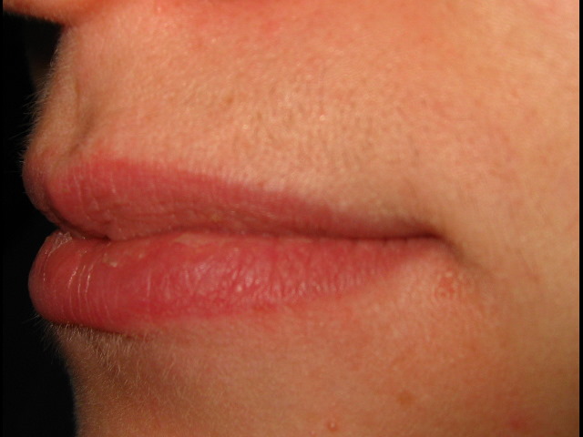 Верхняя губа 6 неделя после пятой процедуры лазерной эпиляции