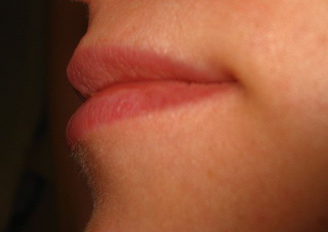 Верхняя губа сразу после седьмой процедуры лазерной эпиляции
