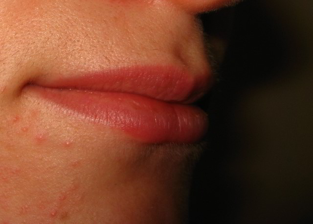 Верхняя губа 5 неделя после шестой процедуры лазерной эпиляции