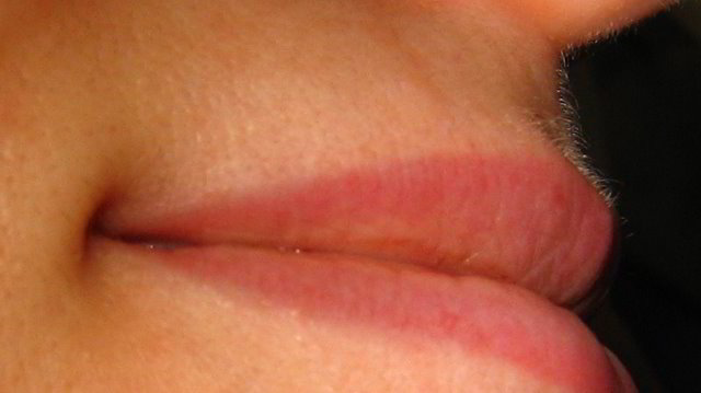 Верхняя губа 3 неделя после третьей процедуры лазерной эпиляции