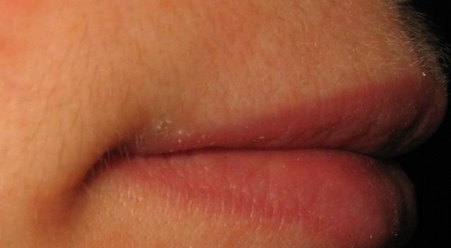 Верхняя губа 11 неделя после третьей процедуры лазерной эпиляции