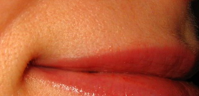 Верхняя губа 5 неделя после третьей процедуры лазерной эпиляции