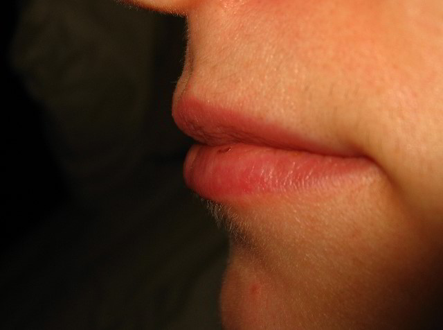 Верхняя губа 12 недель после восьмой процедуры лазерной эпиляции