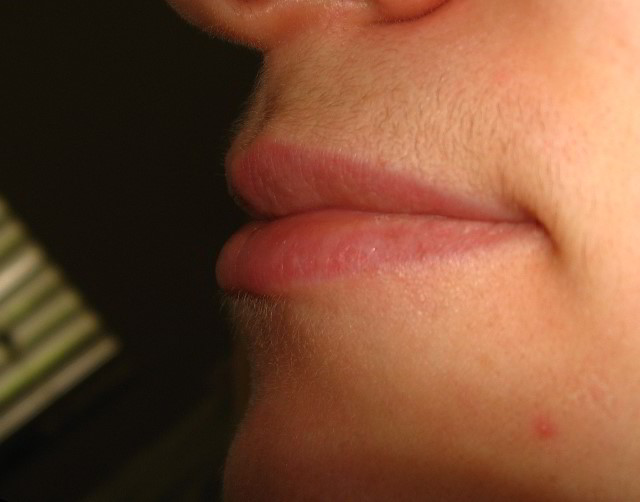 Верхняя губа 10 недель после восьмой процедуры лазерной эпиляции