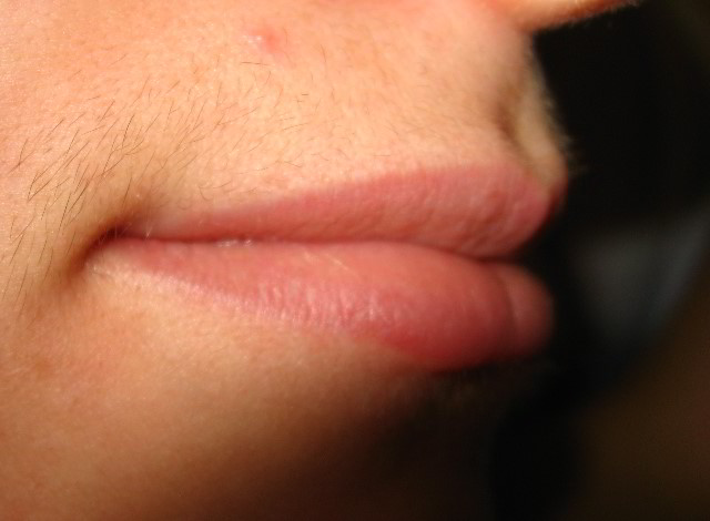 Верхняя губа 10 недель после восьмой процедуры лазерной эпиляции