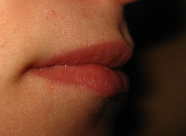Верхняя губа перед восьмой процедурой лазерной эпиляции