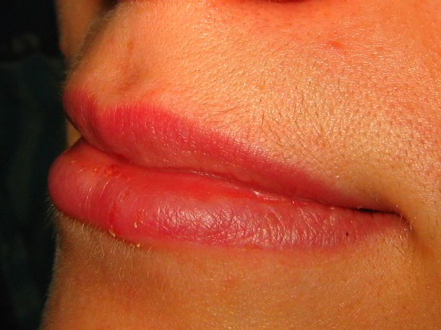 Верхняя губа 5 дней после второй процедуры лазерной эпиляции