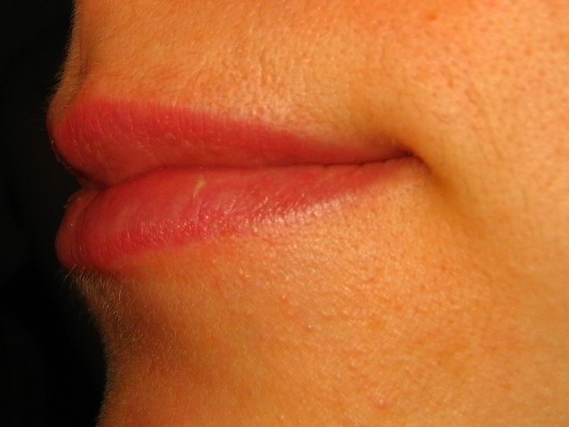 Верхняя губа 4 недели после второй процедуры лазерной эпиляции