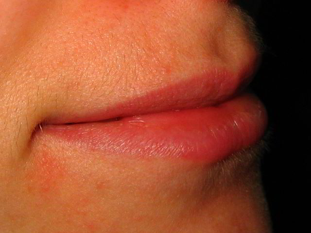 Верхняя губа 7 недель после второй процедуры лазерной эпиляции