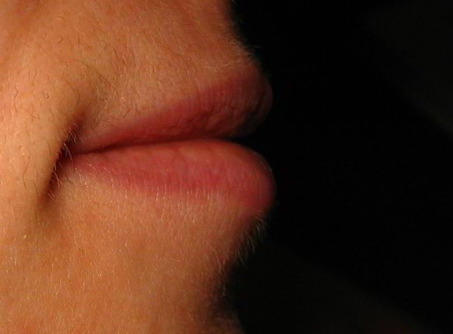 Верхняя губа 6 недель после второй процедуры лазерной эпиляции