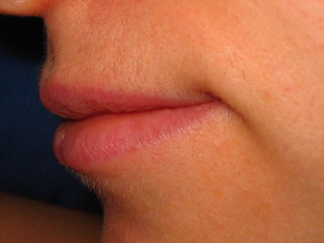 Верхняя губа 6 недель после второй процедуры лазерной эпиляции