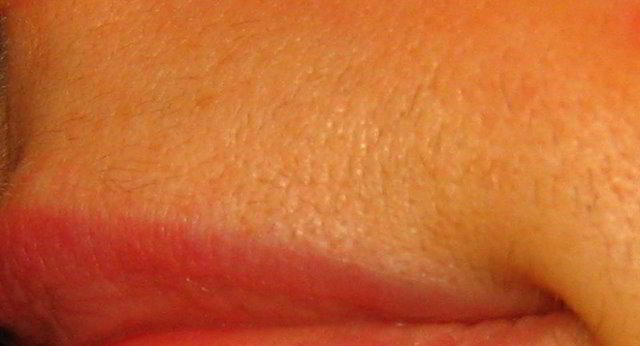 Верхняя губа 9 недель после второй процедуры лазерной эпиляции