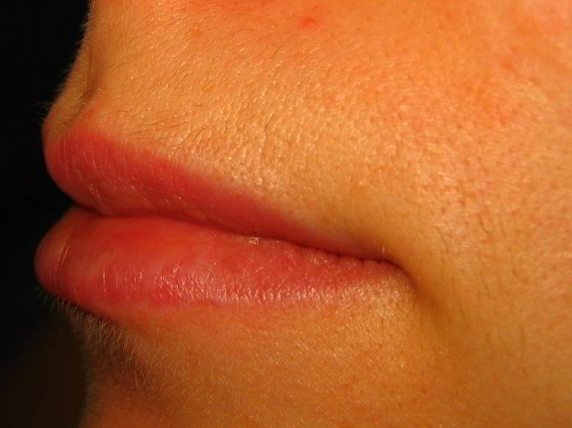 Верхняя губа 3 недели после второй процедуры лазерной эпиляции