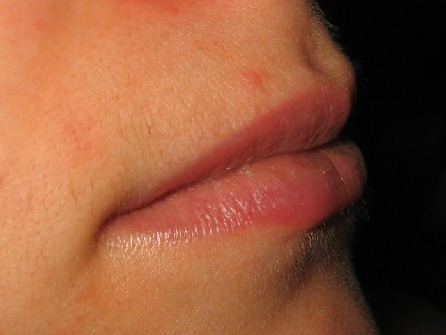 Верхняя губа 2 недели после второй процедуры лазерной эпиляции