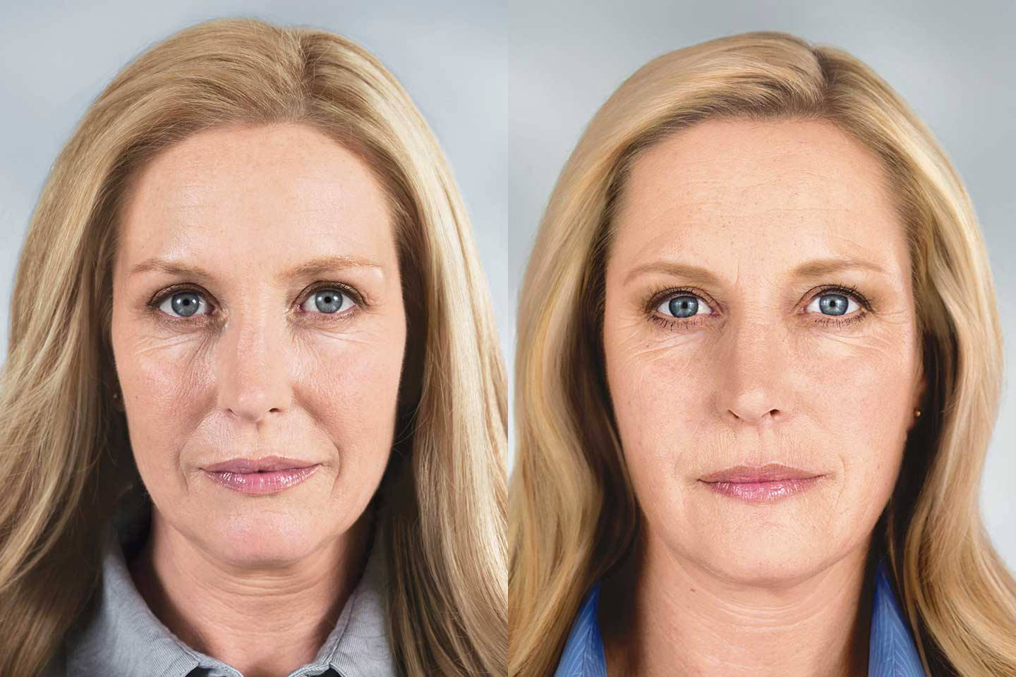 Устранение мимических морщин у женщин диспортом фото до и после