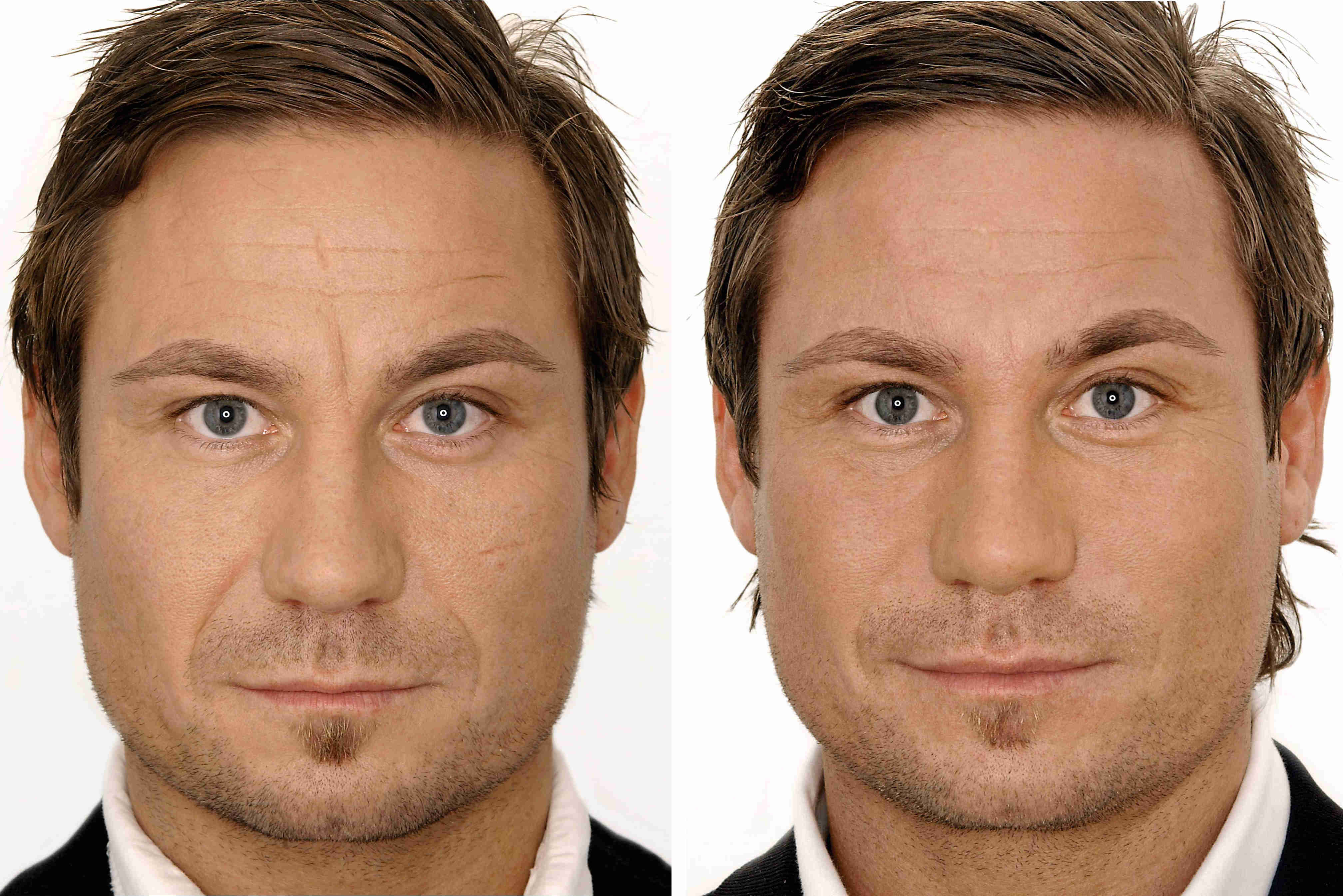 Устранение морщин между бровей у мужчин ботоксом фото до и после