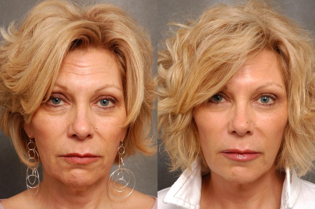 Устранение морщин на лбу у женщин ботоксом фото до и после