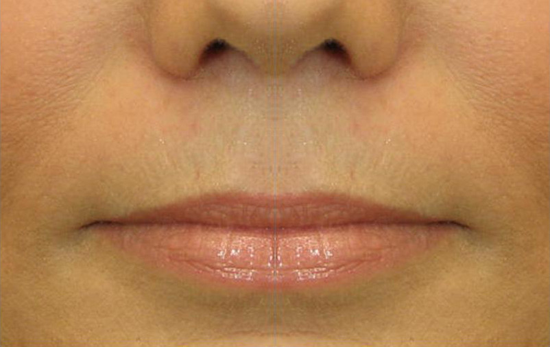 Изменение формы и увеличение объема губ Рестилайном до процедуры
