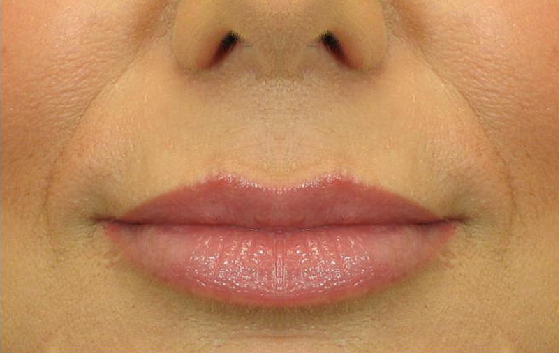 Изменение формы и увеличение объема губ Рестилайном после процедуры