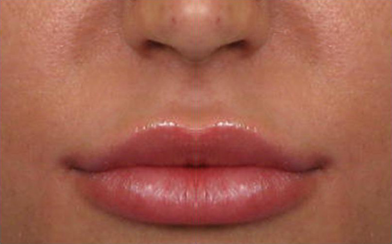 Увеличение губ после процедуры