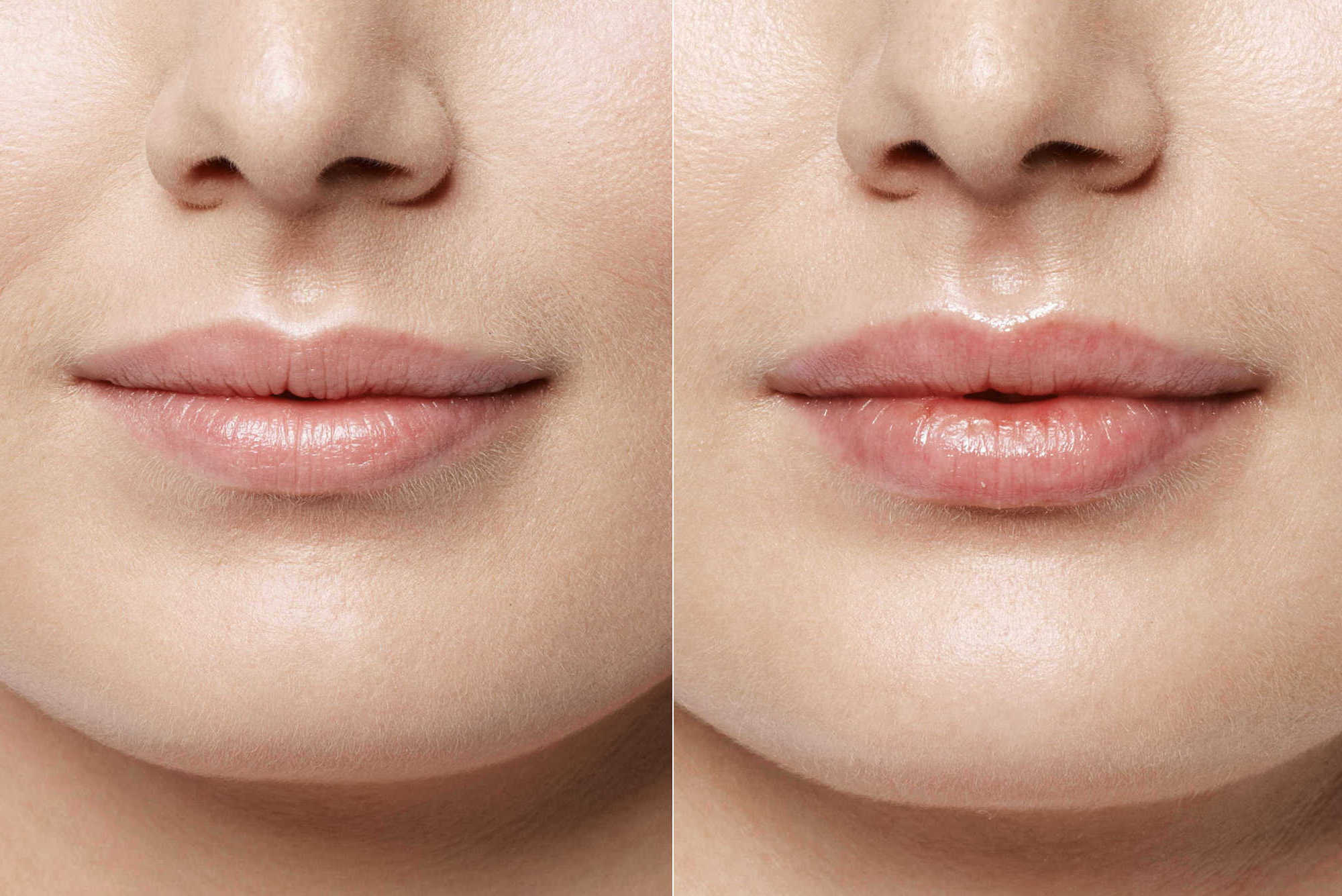 До и после изменения формы и увеличения объема губ рестилайном