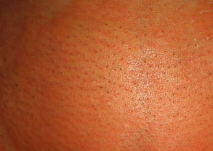 легкий отек кожи после лазерной эпиляции