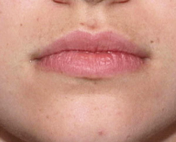 Лазерная эпиляция верхней губы после процедуры