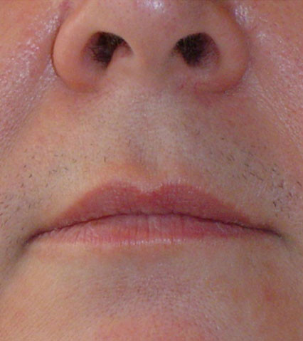 Лазерная эпиляция верхней губы до процедуры