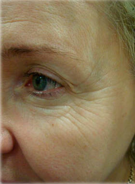 До и через 1 месяц после 2 процедур устранения морщин вокруг глаз до процедуры