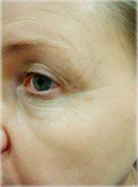 До и через 1 месяц после 2 процедур устранения морщин вокруг глаз после процедуры