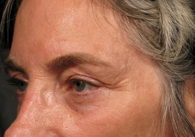 Разглаживание морщин в области внешнего угла глаза и под глазами до процедуры