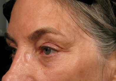 Разглаживание морщин в области внешнего угла глаза и под глазами после процедуры